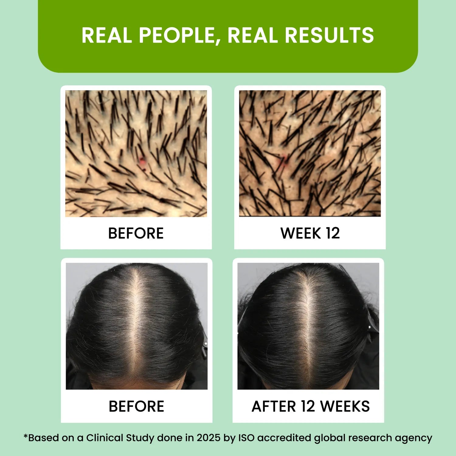 Rosemary Water Hair Spray For Regrowth Buy 1 Get 2 Free